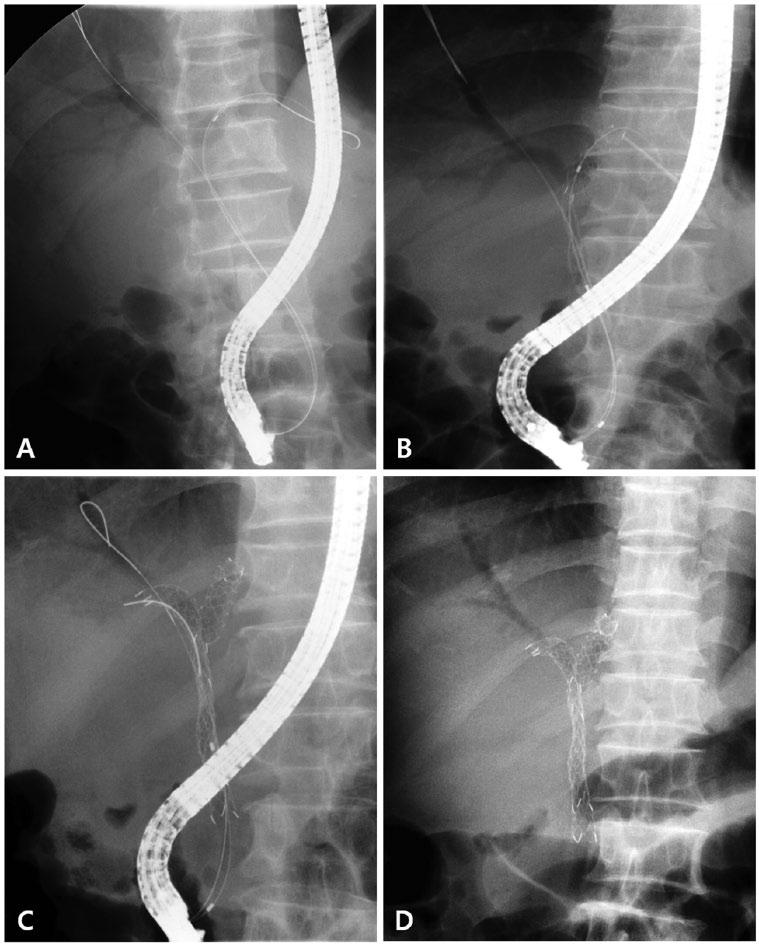 Therapeutic Advances in Gastroenterology 9(2) Figure 2. Procedure of air cholangiography and endoscopic bilateral SIS placement of SEMS. (A) Air cholangiography through a papillotome.
