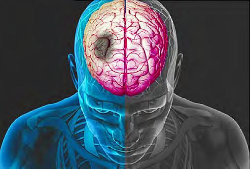5.8 Stroke Mortality A stroke occurs when the blood supply to part of your brain is interrupted or reduced, depriving the brain tissue of adequate oxygen and nutrients.