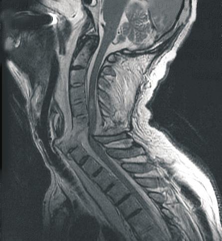 because of a complete fracture of the cervical spine on C6/C7 level, anterior listesis of C7 vertebral body on T1.
