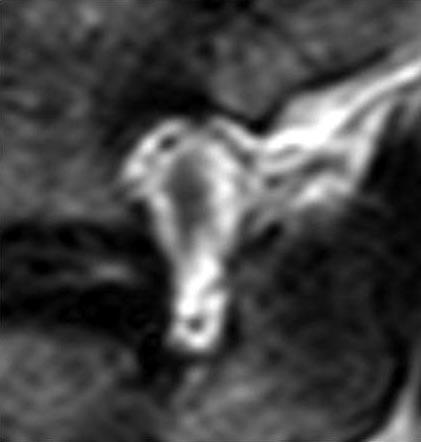 50 lumbar foraminal stenosis is generally addressed through more direct posteriorly-based techniques.
