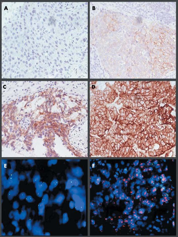 HER2 amplification in breast cancer 711 Figure 1 Images of invasive breast carcinoma captured on the MDS.