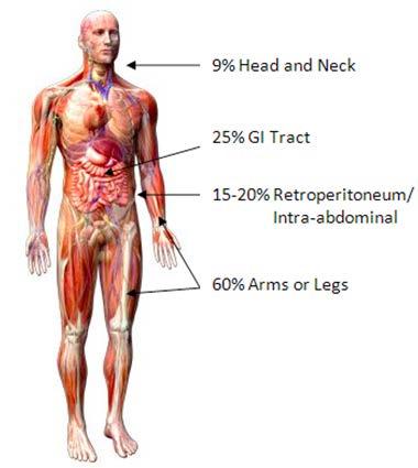 Soft Tissue Sarcoma (STS) Cancer of the soft, connective tissue Affects muscle, fat, blood vessels, nerves, tendons and the lining of joints (synovial tissues) More than 50 different sub-types