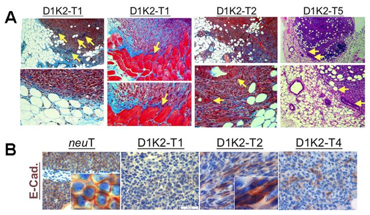 A B Figure 3-4.Tumors formed from MMTV-D1K2 cancer cell lines exhibit stromal invasion and E- cadherin mislocalization/downregulation upon orthotopic implantation.