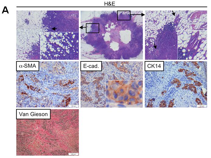 A Figure 3-5.Basal-like breast cancers exhibit an invasive, mixed-lineage phenotype and tumorassociated fibrosis.