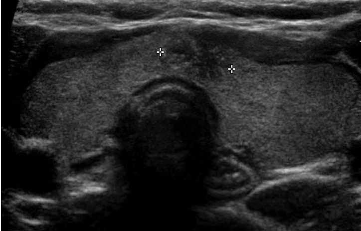 Goitre causes, investigation and management FOCUS RIGHT THYROID <<mass LEFT Esophagus Figure 4. Thyroid ultrasound of a patient with an impalpable nodule incidentally discovered on ultrasound.