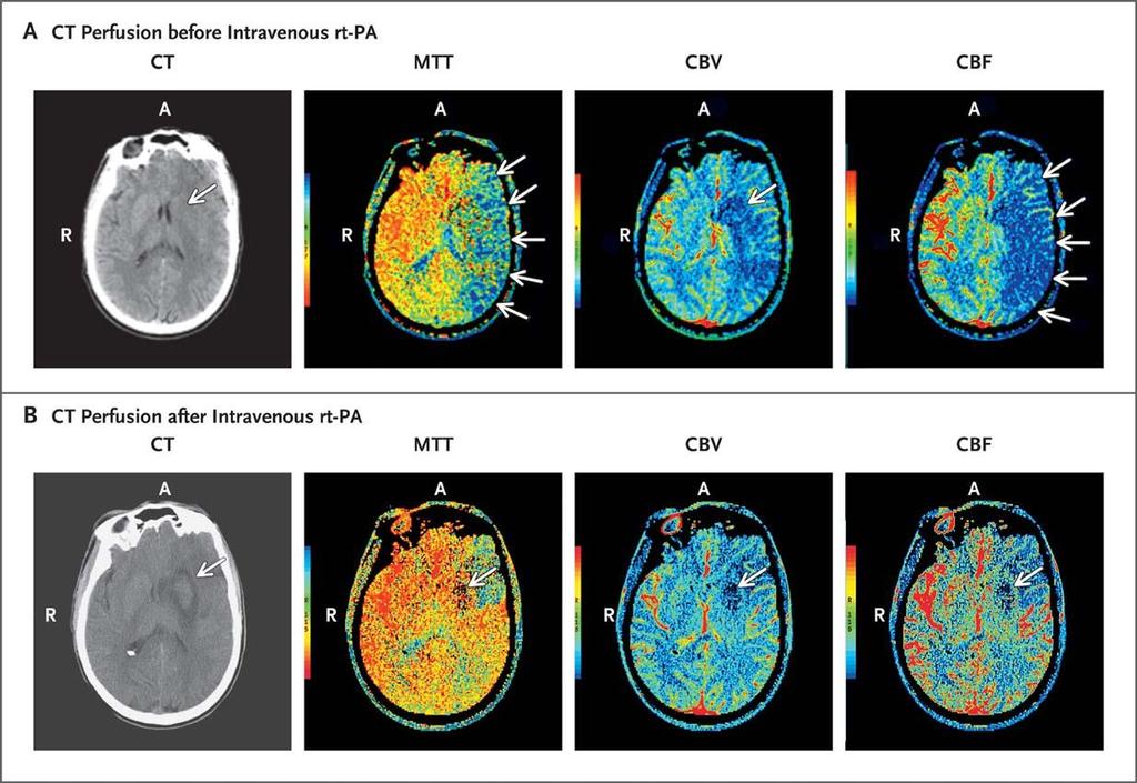 CT Perfusion Imaging in a Patient with Stroke, before and after Thrombolysis with