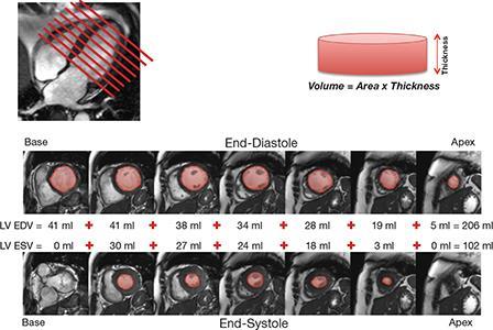 The role of cardiac magnetic resonance in valvular heart disease Typical set of cine images utilizing a steady-state free precession pulse sequence (SSFP).