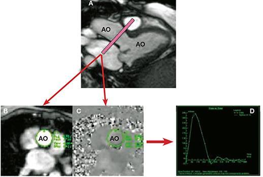 CMR EVALUATION OF AORTIC VALVE Phase-contrast CMR of the aorta to determine aortic stroke volume and flow.
