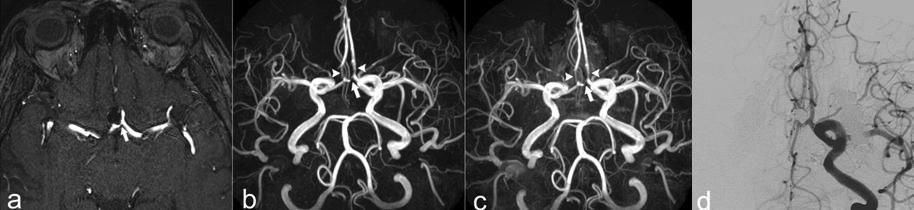 Figure 6 Anterior communicating artery aneurysm with coil-related signal loss in parent and branch vessels. A. Axial unenhanced MOTSA 3D TOF MRA source image obtained 8 months after treatment shows narrowing of the anterior communicating artery (arrow).