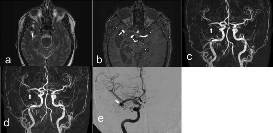 Figure 3 Middle cerebral artery aneurysm with high signal intensity rim artifact and recurrence 6 months after treatment with detachable coils. A.