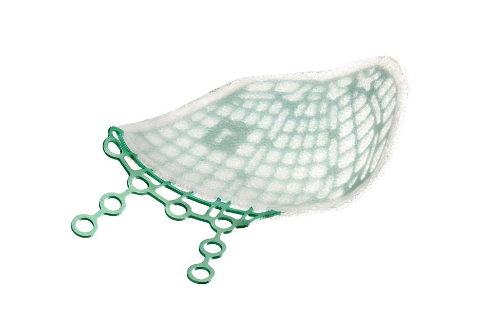 MTB Titanium mesh embedded within a porous polyethylene matrix with a solid, barrier surface on one side, potentially allowing for fibrovascular ingrowth only on the porous side of the implant.