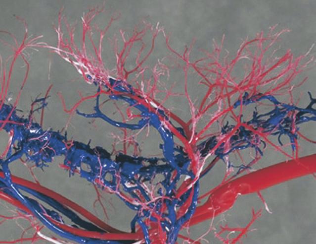 Supraaortic cast shows the importance of the large vertebral arteries, internal thoracic arteries, and large arteriovenous shunt networks laterally in the neck.