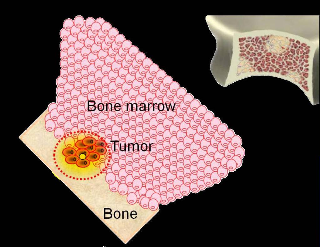 Radium-223 Targets Bone Metastases Range of alpha-particle Radium-223 Bone surface