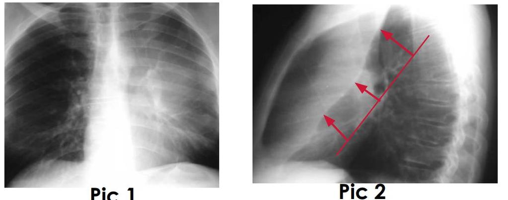 Left Upper lobe Atelectasis: Pic1 : there is area of consolidation on the left lung, we will do lateral view Pic 2 : lateral view of the lung shows a clear cutline which is the oblique