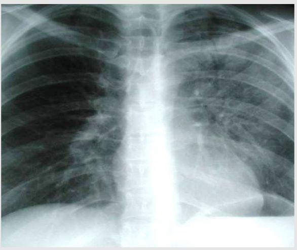 PNEUMONIA - signs : - Air bronchogram - Silhouette - positive or negative - Dense hilum - Spine sign Normally, the thoracic spine appears to become darker (blacker) as you view it from the top to