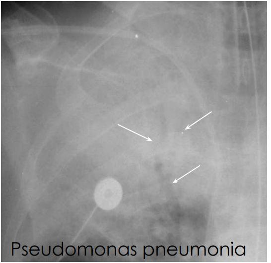 - Dx of pneumonia depends on appropriate clinical scenario.