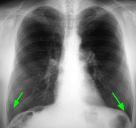 effusion will cause blunting on the lateral and if large enough, the posterior costophrenic sulci. Sometimes a depression of the involved diaphragm will occur.