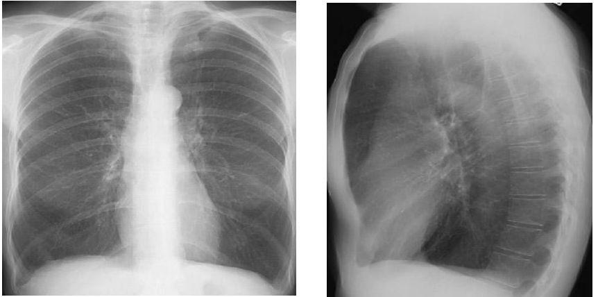 EMPHYSEMA - what is it? - loss of elastic recoil of the lung with destruction of pulmonary capillary bed and alveolar septa.