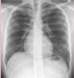 - lung is rigid,there will be difficulty in exhalation of that air as a result distention of lung.