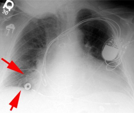 Inspiration: - This greatly helps the radiologist to determine if there are intrapulmonary abnormalities.