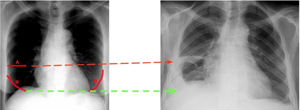 Encysted effusion of transverse fissure (red arrow) and oblique fissures (green arrow) The fissures outlines becomes more clear and thick as they