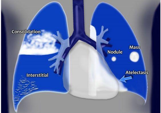 Interstitial = diffuse lung disease MASS Vs. Diffuse Infiltration: - The basic diagnostic instance is to detect an abnormality.