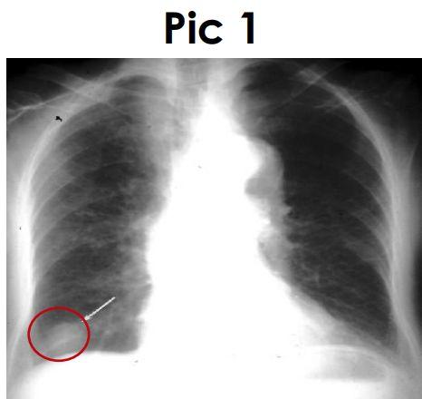 Solitary nodule in the lung - can be totally innocuous harmless or potentially a fatal