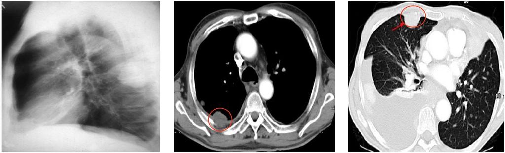 PLEURAL BASED LESION - If the mass arises from the pleura (peripheral mass) it is called Pleural Based Lesion by this name it can help us to minimize and know the Differential diagnosis.