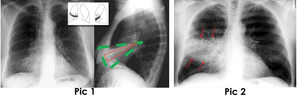PNEUMONIA VS ATELECTASIS Pic 1 : in PA view there is an area of consolidation, is there any loss of volume or not?