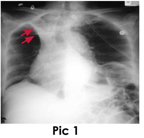 Lobar Atelectasis: - Best sign: shift of a fissure - Rapid development and clearance - Air bronchograms if non-obstructive - Secondary signs: