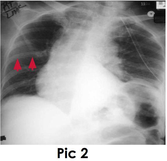 fever, they put intratracheal tube and after they put the tube, he gets dyspnea and after that chest x ray was done and they found : right upper lobe