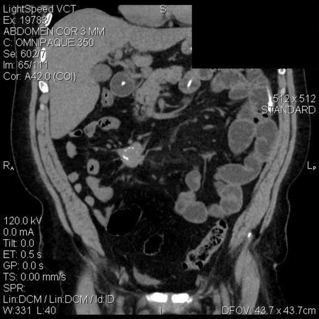 Fig. 14: Tumor of the small intestine.