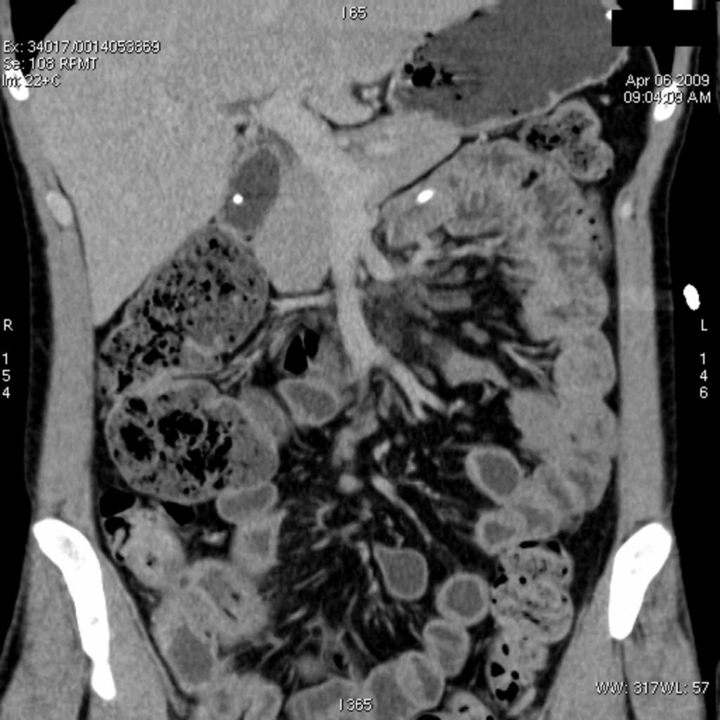 Fig. 3: Crohn's disease - inflammation of terminal ileum with a