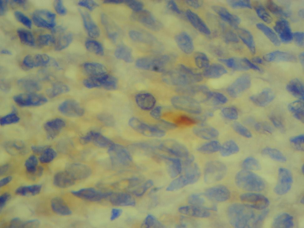 cells of the tumor, positive reaction