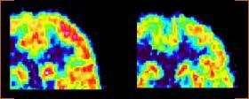 Mental Illness: A Disease of the Brain The brain scan on the left reflects normal