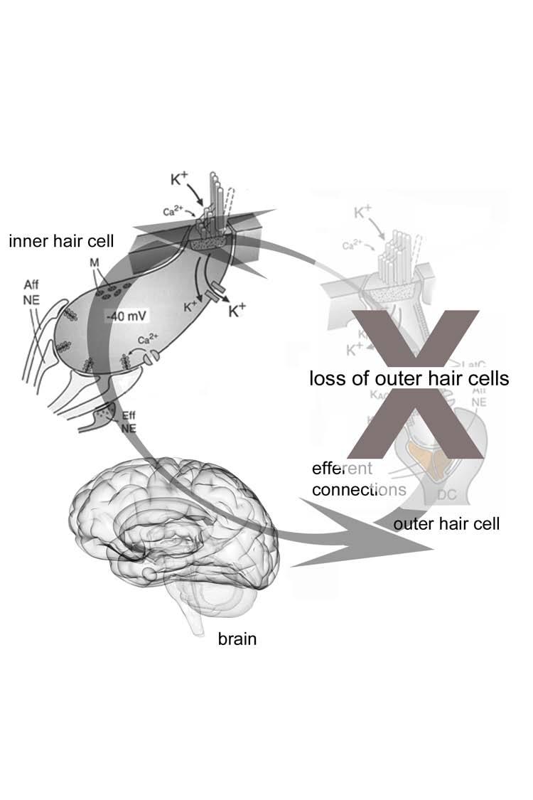 Sensorineural hearing loss usually involves loss of outer hair