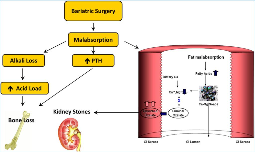 Bariatric Surgery Effects on Bone and