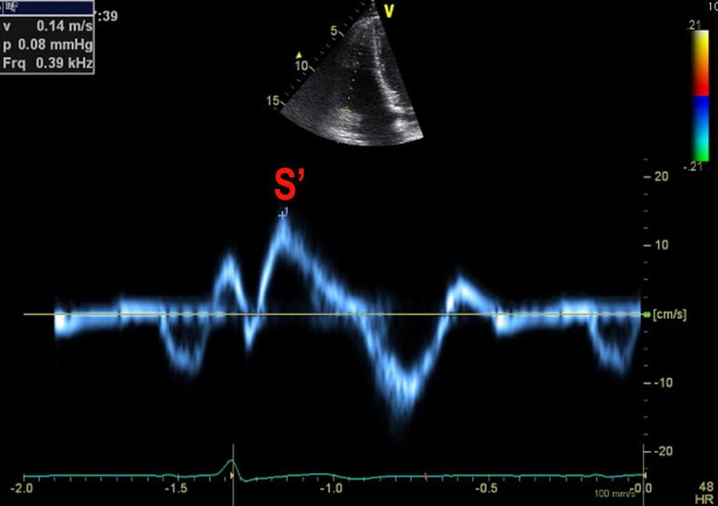 Methods: Echo Imaging Protocols Tricuspid annular peak systolic