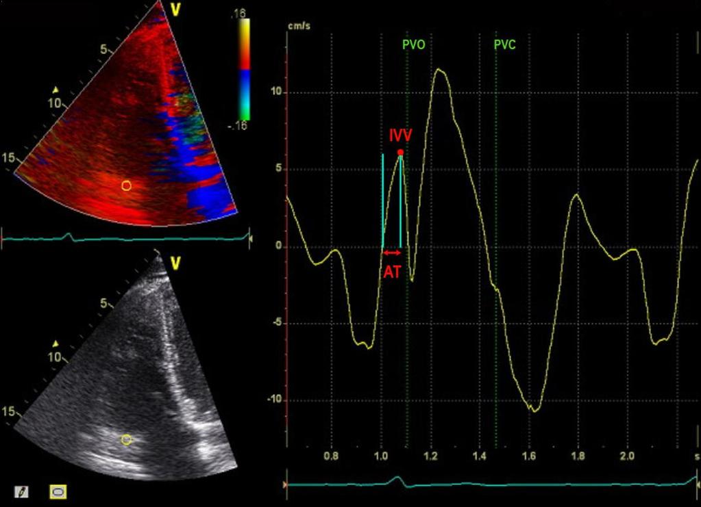 Methods: Echo Imaging Protocols Myocardial acceleration during isovolumic