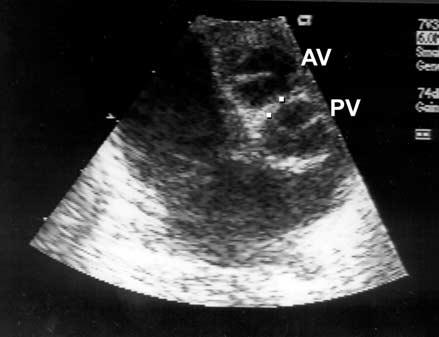 Ann Thorac Surg KIM ET AL 2003;76:1906 10 COMMISSURAL MALALIGNMENT IN TGA 1907 Fig 1. Echocardiographic view showing commissural malalignment (sinus-facing pattern of pulmonary valve [PV]).
