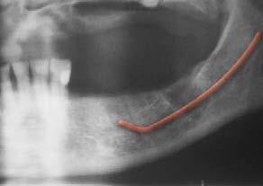 Bicon Short Implants Case Study: Avoid Grafting by Dr.