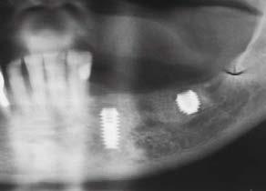 nerve. Post-operative radiograph two years after final restoration.