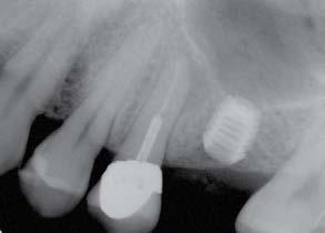 Radiograph of short implant 18 months post crown insertion.