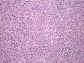naglašenom tumorskom nekrozom (koja nije uvek prisutna). Celularnost visoka, mitotske figure brojne, najčešće više od 15/10HPF, a vaskularna invazija prisutna u 25% slučajeva.