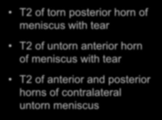 Analysis of Knee T2 Maps T2 of torn posterior horn of meniscus with tear T2 of untorn anterior