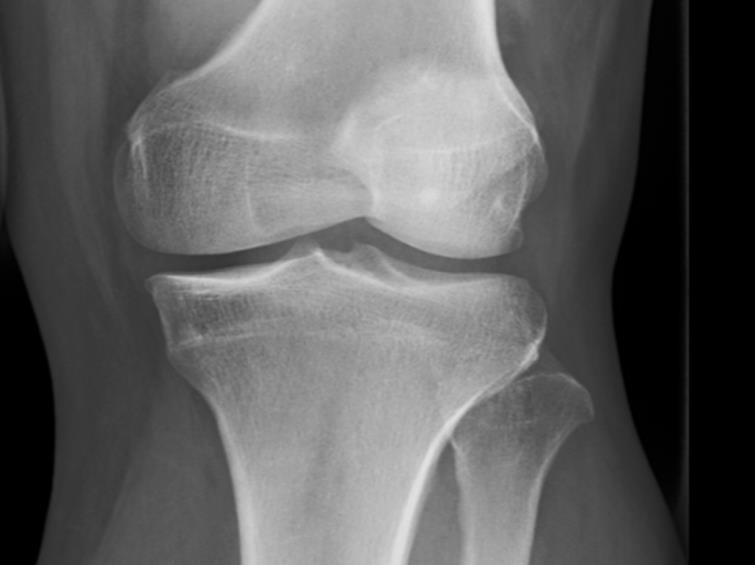 Review of Knee Radiographs Knee radiographs reviewed to determine severity of knee joint degeneration using Kellgren-Lawrence (KL) grading