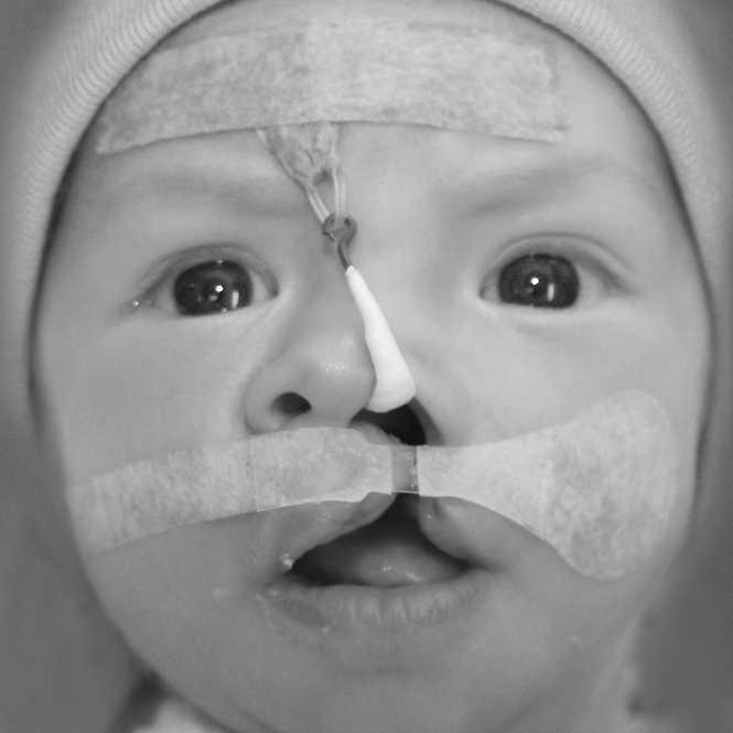 Monasterio et al., COMPARATIVE STUDY OF NASOALVEOLAR MOLDING 549 FIGURE 1 A 2-month-old patient with a complete left cleft lip and palate treated with nasal elevator and DynaCleftt from 7 days of age.