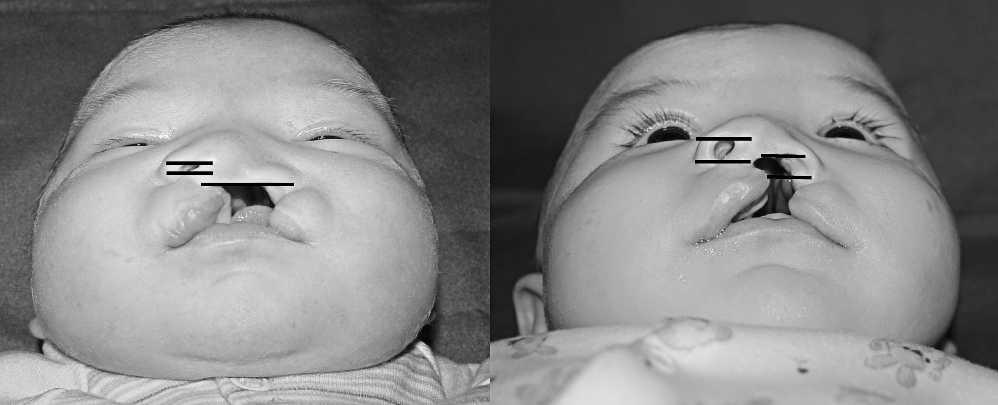550 Cleft Palate-Craniofacial Journal, September 2013, Vol. 50 No. 5 FIGURE 5 Photograph measurements of the columellar angle in a patient with complete left cleft lip and palate.