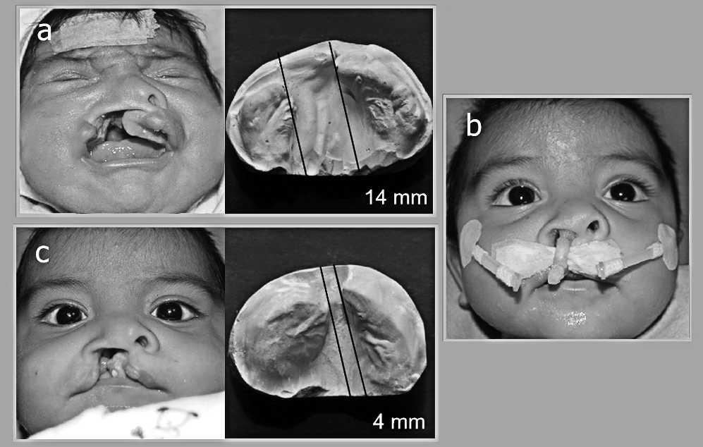 552 Cleft Palate-Craniofacial Journal, September 2013, Vol. 50 No. 5 FIGURE 10 Patient with a complete right cleft lip and palate treated with NAM-Grayson. The treatment began at 10 days of age.