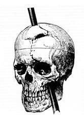 The famous case of Phineas Gage survived an accident in which a large iron rod was